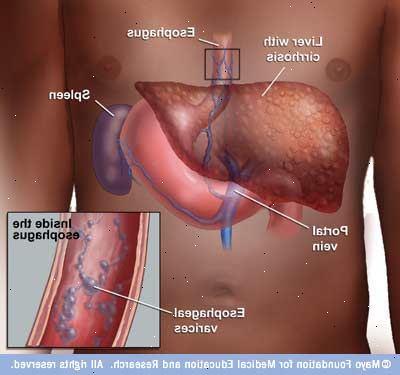 Esophageal varicer. Alvorlig leveren arrdannelse (skrumplever). Esophageal varicer. Alvorlig leveren arrdannelse (skrumplever).