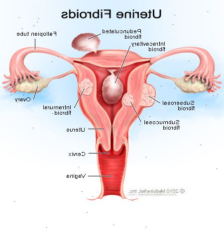Livmor fibroids. Andre vekstfaktorer. Livmor fibroids. Andre vekstfaktorer.
