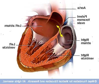 Patent foramen ovale. Normal hjertefunksjon. Patent foramen ovale. Normal hjertefunksjon.