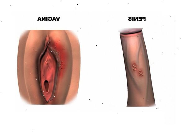 Genital herpes. Tilbakefall er vanlig. Genital herpes. Tilbakefall er vanlig.