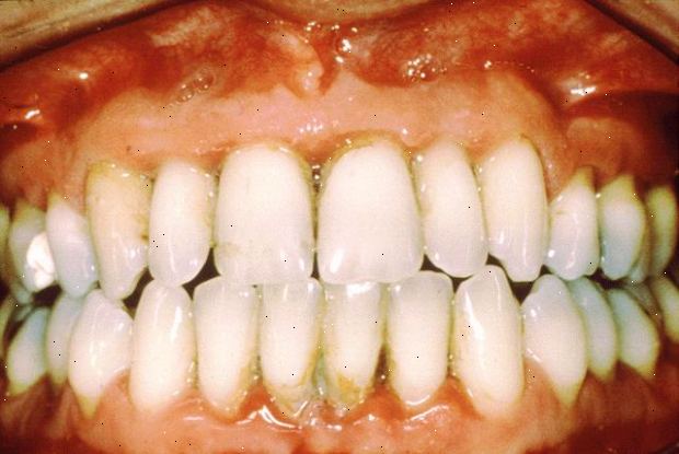 Gingivitt. Når bør du oppsøke en tannlege. Gingivitt. Når bør du oppsøke en tannlege.