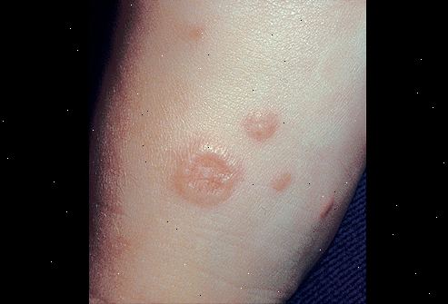 Granuloma annulare. Kortikosteroid kremer eller salver. Granuloma annulare. Kortikosteroid kremer eller salver.