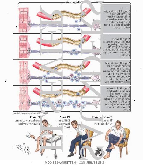 Guillain-Barré syndrom. Søk medisinsk hjelp. Guillain-Barré syndrom. Søk medisinsk hjelp.