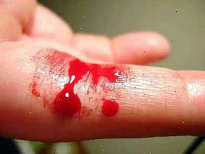 Hemofili. Babyer med hemofili. Hemofili. Babyer med hemofili.