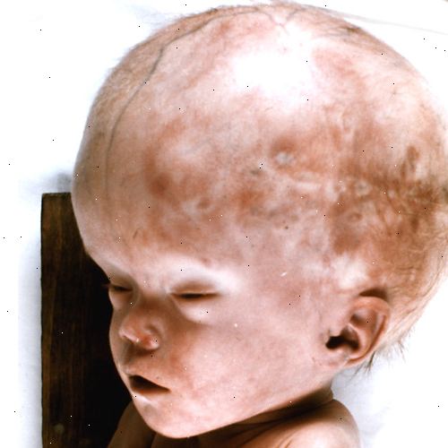 Hydrocephalus. Søk medisinsk omsorg for spedbarn og småbarn. Hydrocephalus. Søk medisinsk omsorg for spedbarn og småbarn.