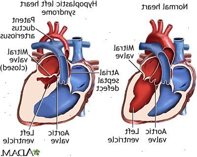 Hypoplastic venstre hjerte syndrom. Hva skjer i hypoplastic venstre hjerte syndrom. Hypoplastic venstre hjerte syndrom. Hva skjer i hypoplastic venstre hjerte syndrom.