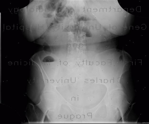 Intestinal obstruksjon. Mekanisk obstruksjon av tynntarmen. Intestinal obstruksjon. Mekanisk obstruksjon av tynntarmen.