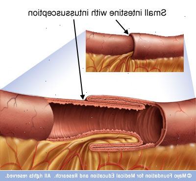 Intussusception. Unormal intestinal formasjon ved fødselen. Intussusception. Unormal intestinal formasjon ved fødselen.