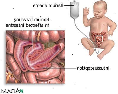 Forberedelser til din avtale. En tidligere historie med intussusception. Forberedelser til din avtale. En tidligere historie med intussusception.