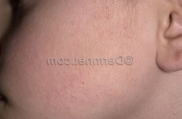 Keratose pilaris. Gå lett på huden din. Keratose pilaris. Gå lett på huden din.