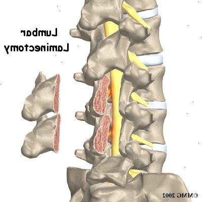 Laminectomy. Definisjon. Laminectomy. Definisjon.
