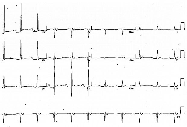 Forberedelser til din avtale. Aortastenose. Forberedelser til din avtale. Aortastenose.