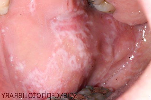 Oral lichen planus. Andre tegn eller symptomer. Oral lichen planus. Andre tegn eller symptomer.