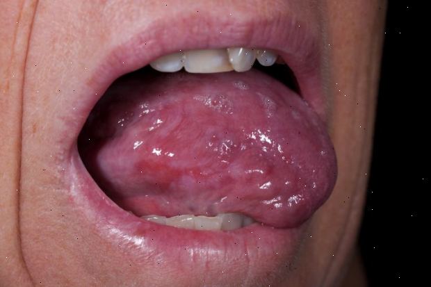 Forberedelser til din avtale. Andre typer lichen planus. Forberedelser til din avtale. Andre typer lichen planus.