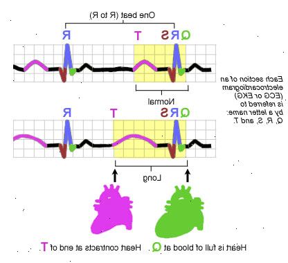 Lang QT syndrom. Langvarig q-T-intervall. Lang QT syndrom. Langvarig q-T-intervall.