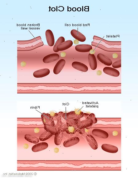 Trombocytopeni (lavt antall blodplater). Fangst av blodplater i milten. Trombocytopeni (lavt antall blodplater). Fangst av blodplater i milten.