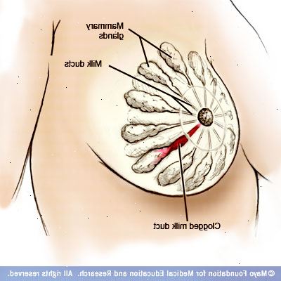 Mammary duct ectasia. Brystvev endringer på grunn av aldring. Mammary duct ectasia. Brystvev endringer på grunn av aldring.