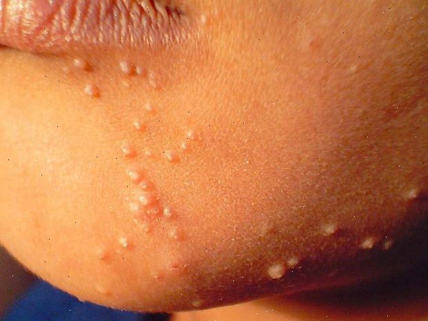 Molluscum contagiosum. Unngå å ta på humper. Molluscum contagiosum. Unngå å ta på humper.