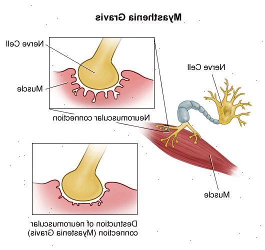 Myasthenia gravis. Problemer med å svelge. Myasthenia gravis. Problemer med å svelge.