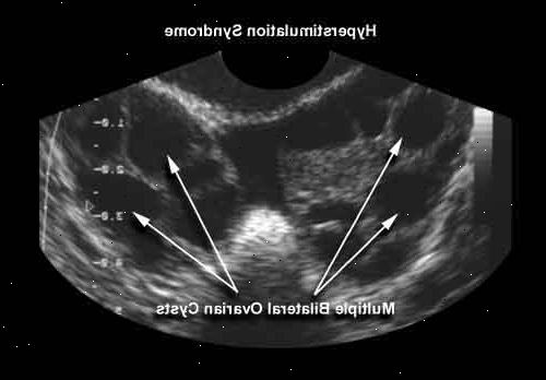 Ovarialt hyperstimuleringssyndrom. Justere medisinering dosering. Ovarialt hyperstimuleringssyndrom. Justere medisinering dosering.