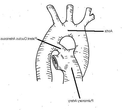 Patent ductus arteriosus (PDA). Å bli født for tidlig (prematur). Patent ductus arteriosus (PDA). Å bli født for tidlig (prematur).
