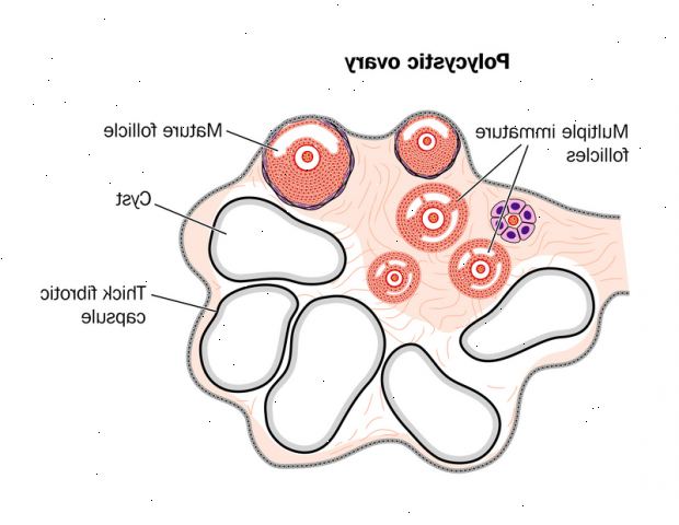 Polycystisk ovariesyndrom. Menstrual abnormitet. Polycystisk ovariesyndrom. Menstrual abnormitet.