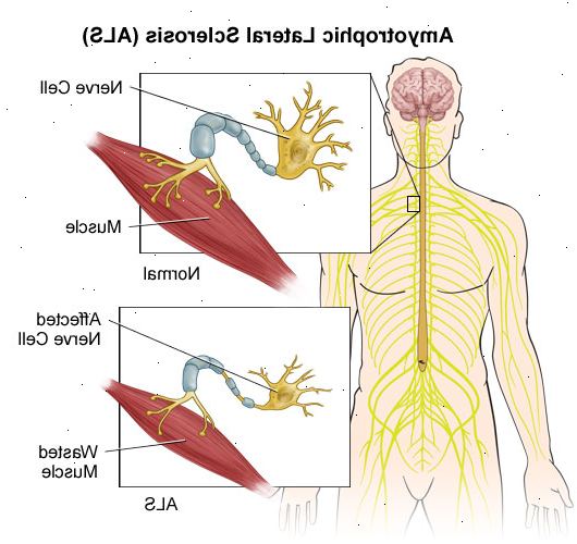Amyotrofisk lateral sklerose. Uorganisert immunrespons. Amyotrofisk lateral sklerose. Uorganisert immunrespons.