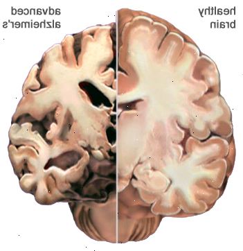 Alzheimers sykdom. Lungebetennelse og andre infeksjoner. Alzheimers sykdom. Lungebetennelse og andre infeksjoner.
