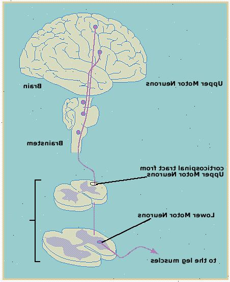 Primær lateral sklerose (PLS). Magnetic resonance imaging (MRI). Primær lateral sklerose (PLS). Magnetic resonance imaging (MRI).