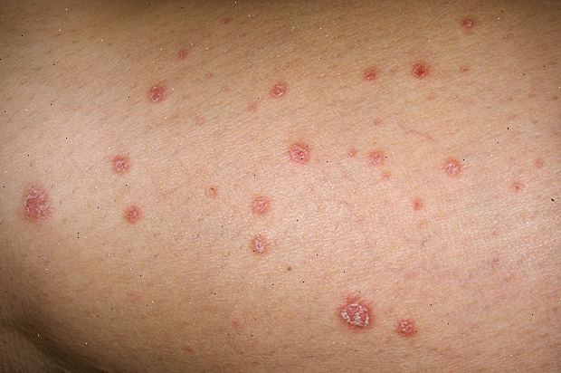 Psoriasis. Erytrodermisk psoriasis. Psoriasis. Erytrodermisk psoriasis.