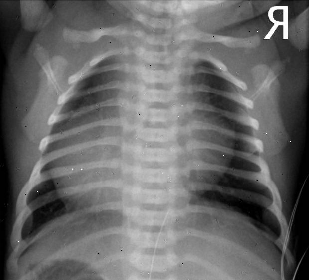 Pulmonal atresi. Røde hunder (tysk meslinger). Pulmonal atresi. Røde hunder (tysk meslinger).