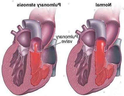 Pulmonal ventilen stenose. Normal lunge ventilen anatomi. Pulmonal ventilen stenose. Normal lunge ventilen anatomi.