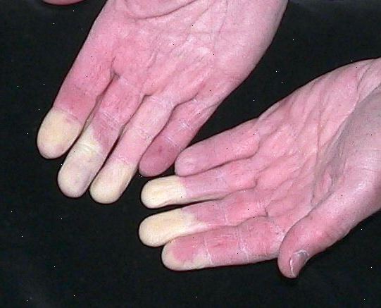 Raynauds sykdom. Blodkar i krampe. Raynauds sykdom. Blodkar i krampe.