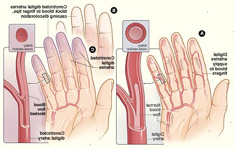 Forberedelser til din avtale. Primær vs Sekundær Raynauds. Forberedelser til din avtale. Primær vs Sekundær Raynauds.