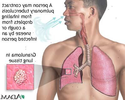 Tuberkulose. Hva organer er berørt? Tuberkulose. Hva organer er berørt?