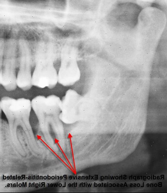 Tann abscess. En diett høy i sukker. Tann abscess. En diett høy i sukker.