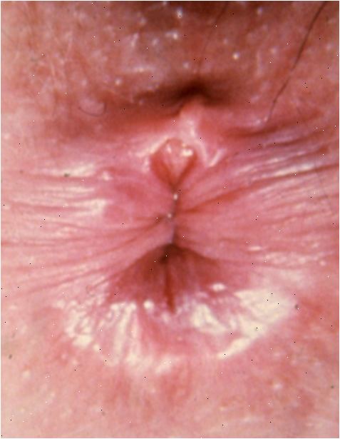 Anal fissur. Revne som strekker seg til omkringliggende muskulaturen. Anal fissur. Revne som strekker seg til omkringliggende muskulaturen.