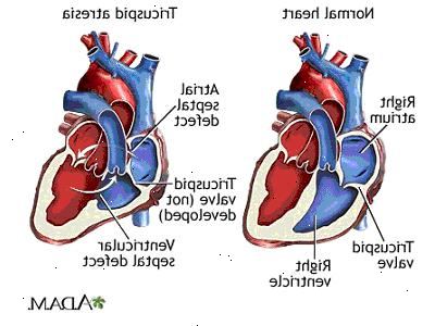 Tricuspid atresi. Den normale fungerende hjerte. Tricuspid atresi. Den normale fungerende hjerte.