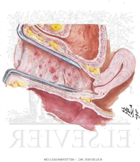 Vaginal tørrhet. Spør hvis det er noe du trenger å gjøre på forhånd. Vaginal tørrhet. Spør hvis det er noe du trenger å gjøre på forhånd.
