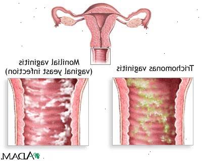 Gjær infeksjon (vaginal). Økt østrogennivå. Gjær infeksjon (vaginal). Økt østrogennivå.