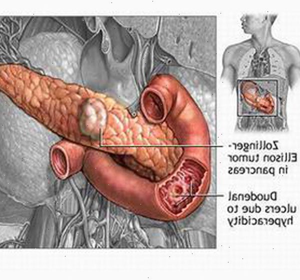 Zollinger-Ellison-syndrom. Assosiasjon med MEN I. Zollinger-Ellison-syndrom. Assosiasjon med MEN I.