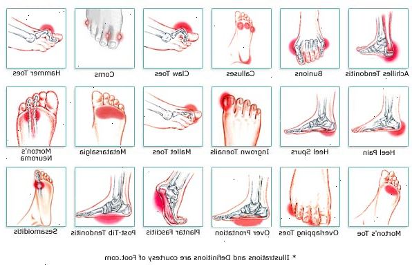 Foot smerte. Oppsøke lege umiddelbart hvis du. Foot smerte. Oppsøke lege umiddelbart hvis du.