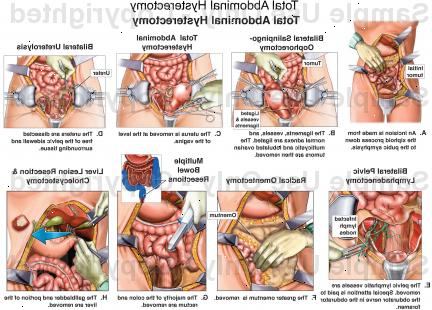 Abdominal hysterektomi. Unormal vaginal blødning. Abdominal hysterektomi. Unormal vaginal blødning.