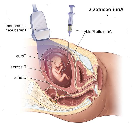Fostervannsprøve. Du hadde positive resultater fra en prenatal screening test. Fostervannsprøve. Du hadde positive resultater fra en prenatal screening test.