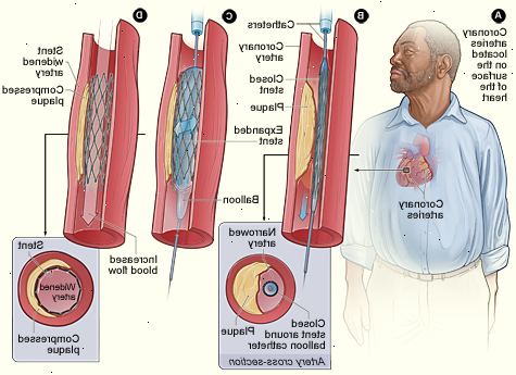 Angioplastikk og stent. Re-innsnevring av arterien din (restenose). Angioplastikk og stent. Re-innsnevring av arterien din (restenose).