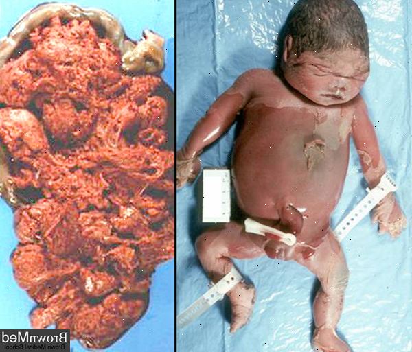Forberedelser til din avtale. Forstørret milt (splenomegali). Forberedelser til din avtale. Forstørret milt (splenomegali).