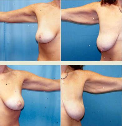 Arm lift. Asymmetri i form av armene dine. Arm lift. Asymmetri i form av armene dine.