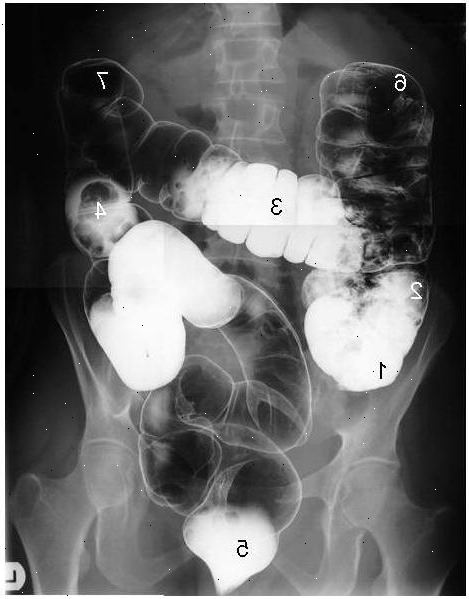 Barium klyster. Single-kolonnen barium klyster. Barium klyster. Single-kolonnen barium klyster.
