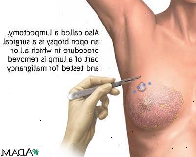 Ultralyd-veiledet kjerne nål biopsi. MRI-guided kjerne nål biopsi. Ultralyd-veiledet kjerne nål biopsi. MRI-guided kjerne nål biopsi.