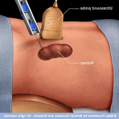 Nyre biopsi. Arteriovenøs fistel. Nyre biopsi. Arteriovenøs fistel.